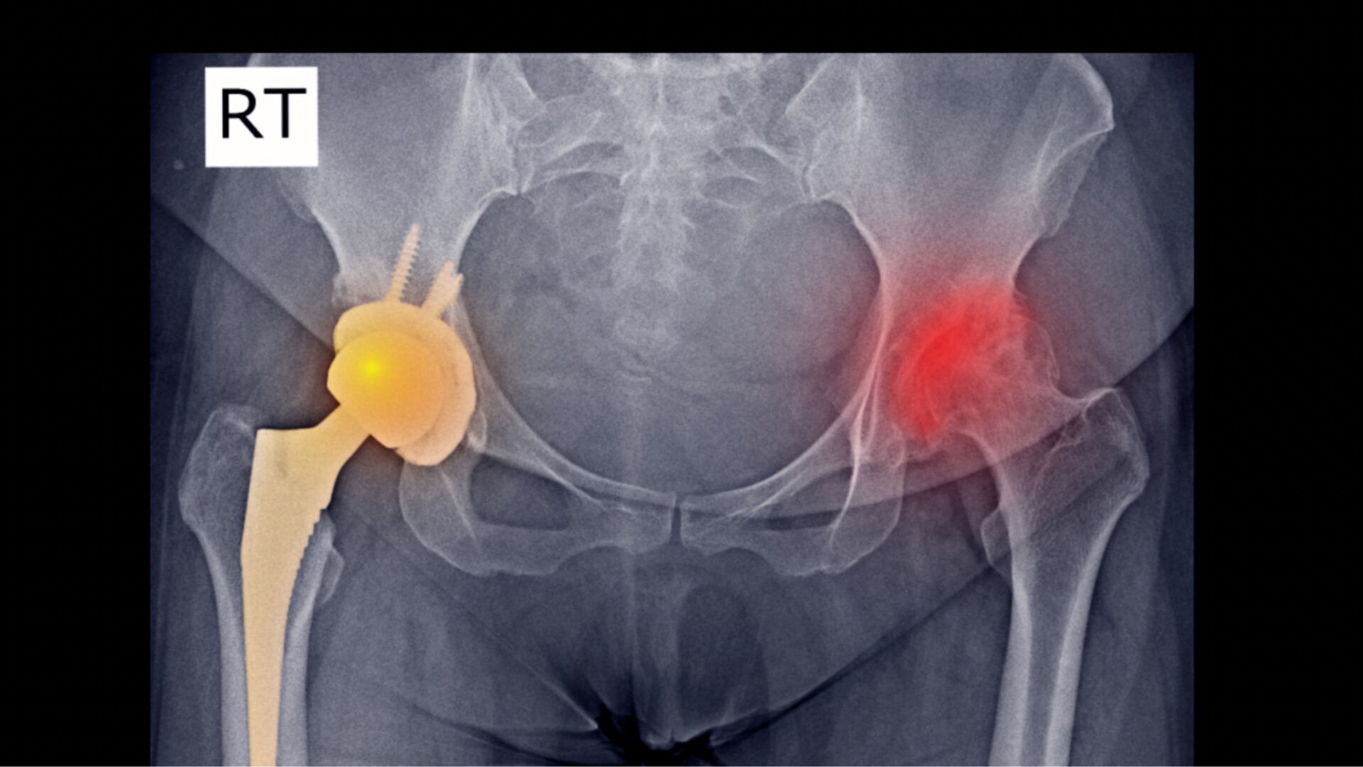 postop. Physiotherapie